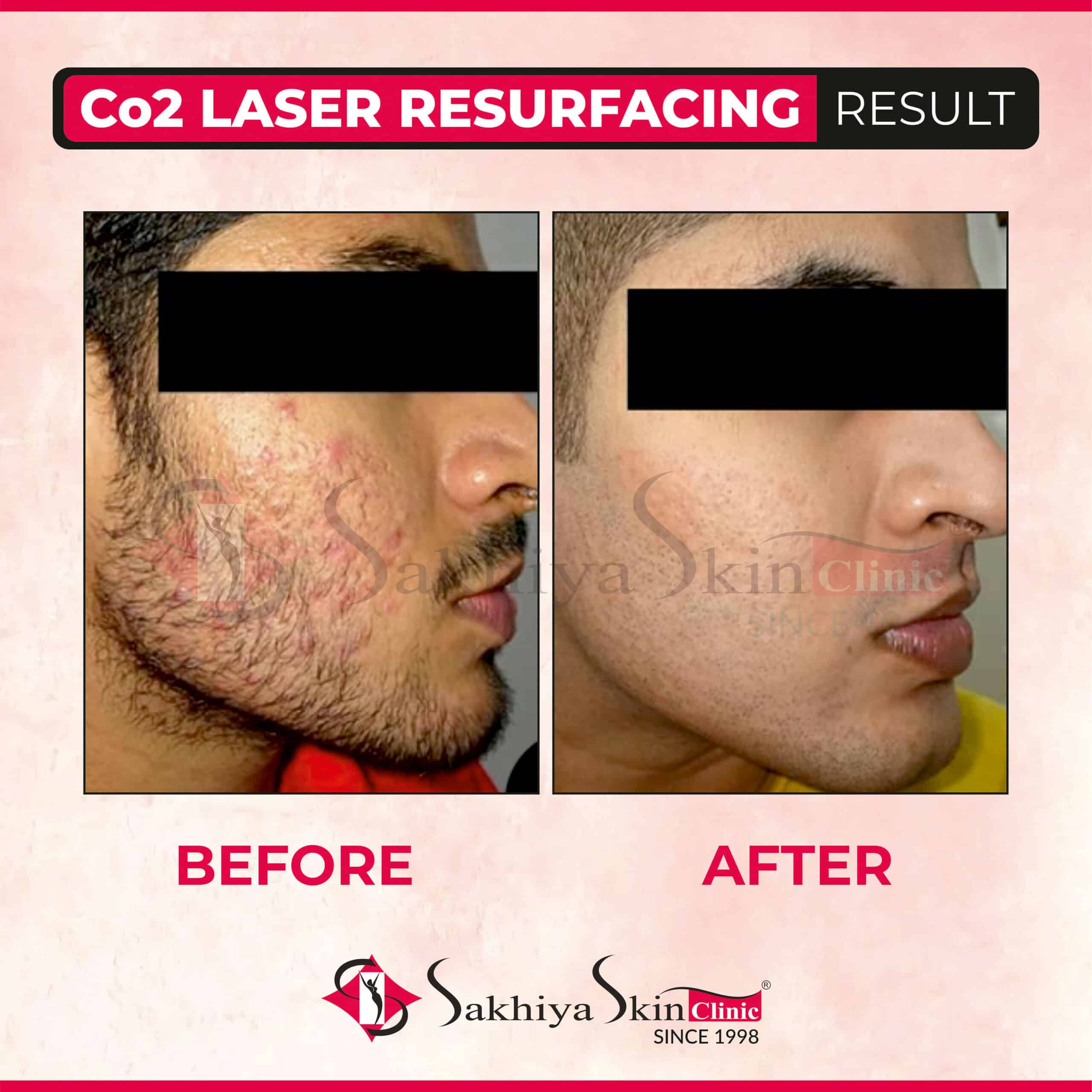 fractional co2 laser before and after