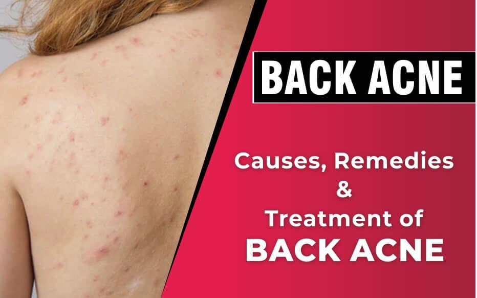 Back Acne - Sakhiya Skin Clinic