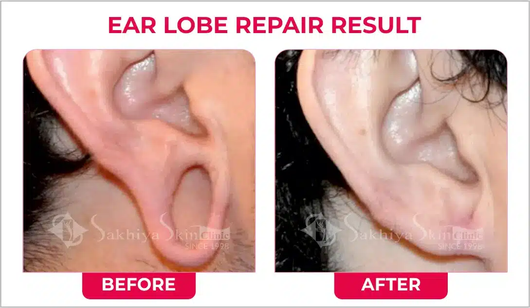 Ear Lobe Repair Surgery, Ear Lobe Repair Treatment - Sakhiya Skin