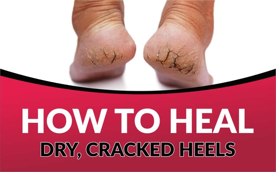 Dry Cracked Feet Can Be Soothed Naturally in 3 Easy Steps