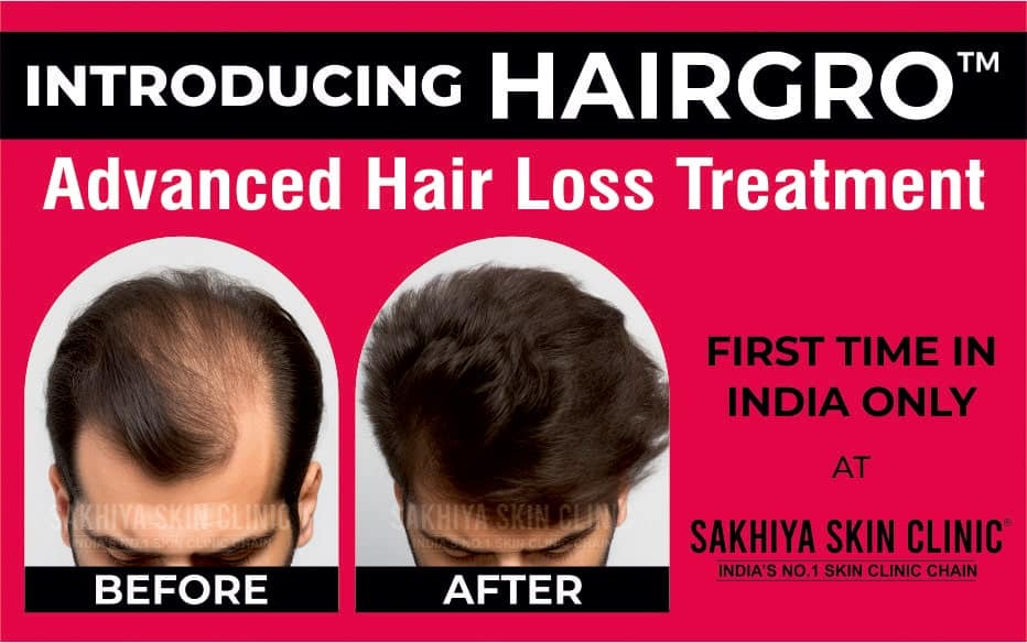 Hairgro Treatment For Hair Loss