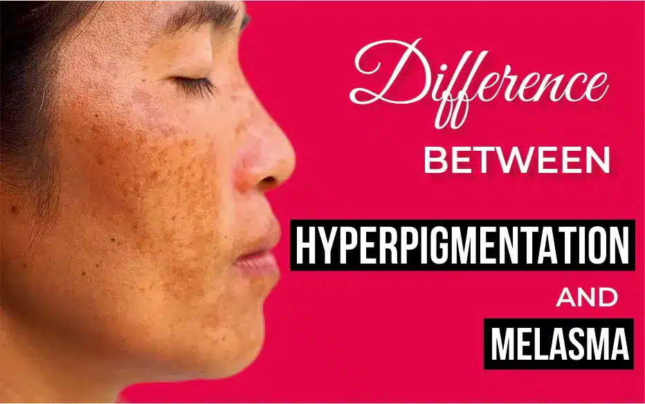 Difference between hyperpigmentation and melasma
